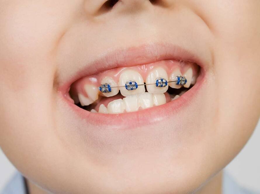 Dental Braces
