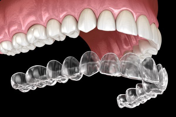 Invisalign treatment in Vasanth Nagar