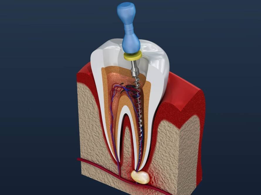 Root Canal Treatments