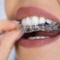 Cost of Invisalign Clear Aligners near Cunningham Road